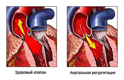 Причины отсутствия регургитации