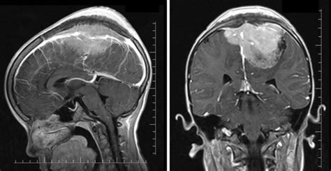 Причины парасагиттальной опухоли