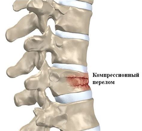 Причины перекрученного позвоночника