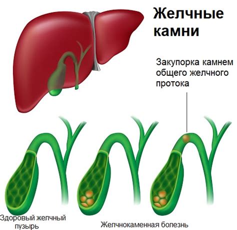 Причины перерастяжения желчного пузыря