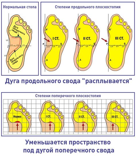 Причины плоскостопия у детей