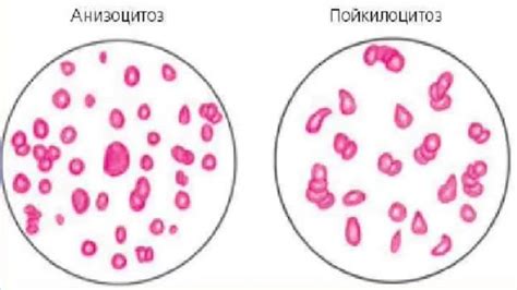 Причины пойкилоцитоза слабовыраженного