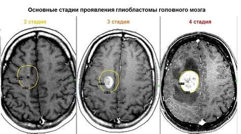 Причины полного регресса опухоли