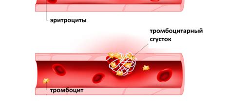 Причины понижения протромбинового отношения