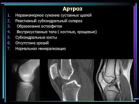 Причины пониженного объема суставных щелей