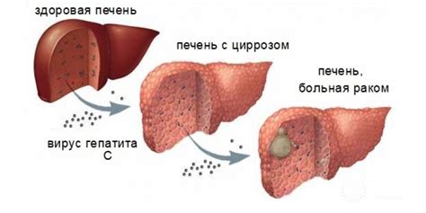 Причины появления мелкозернистой текстуры печени