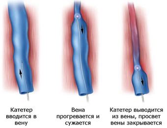 Причины появления расширенных вен