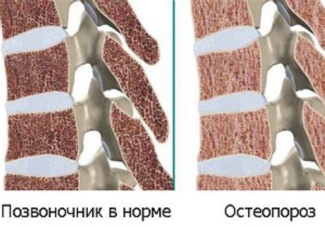 Причины развития остеопороза позвоночника