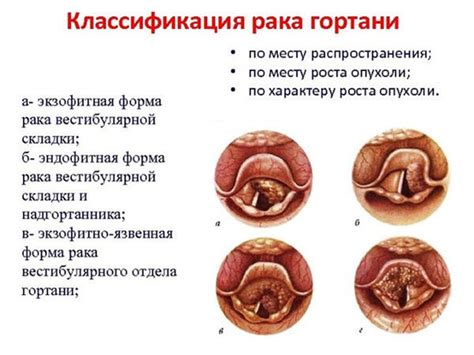 Причины развития рака гортани второй степени