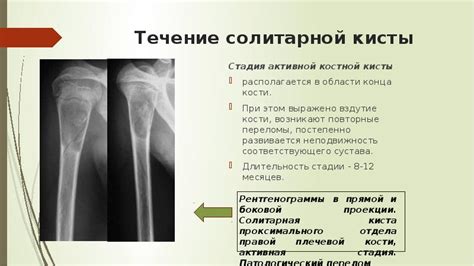 Причины развития солитарной кисты