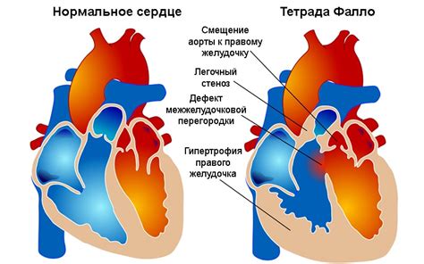 Причины развития тетрады Фалло