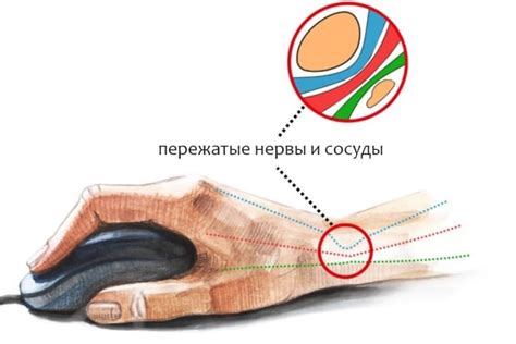 Причины развития туннельного синдрома ноги