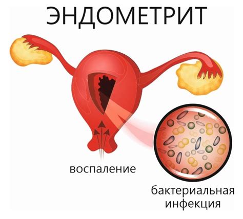 Причины развития хронического эндометрита у женщин