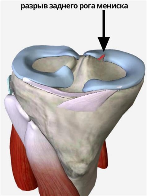 Причины разрыва заднего рога медиального мениска