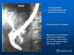 Причины расширения холедоха печени