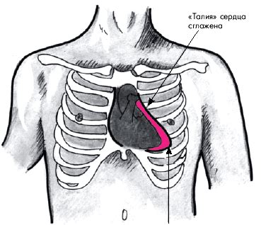 Причины сглаженной талии сердца