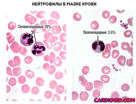 Причины сдвига лейкоцитарной формулы вправо у взрослых