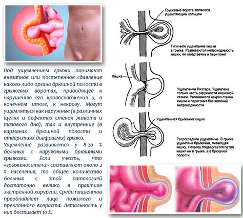 Причины секвестирования грыжи