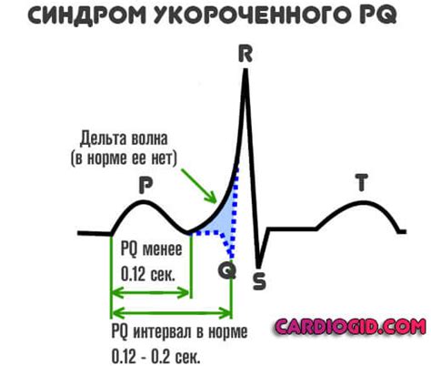 Причины синдрома укороченного pq у детей