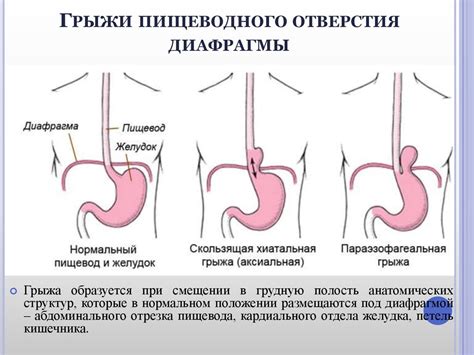 Причины скользящей грыжи пищеводного отверстия диафрагмы