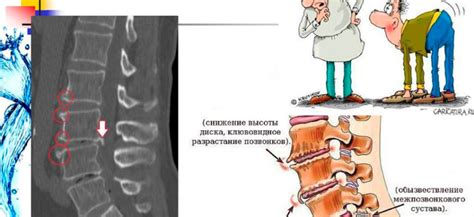 Причины спондилеза позвоночника