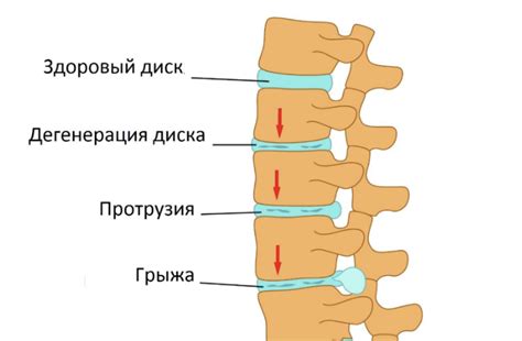 Причины субартикулярной протрузии диска