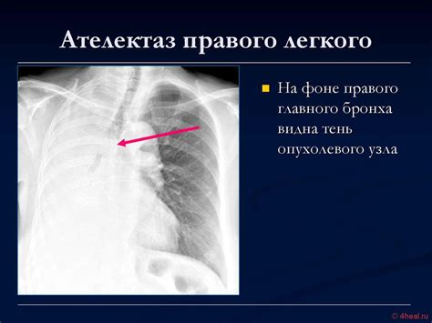 Причины субсегментарного ателектаза правого легкого