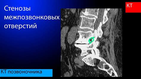 Причины сужения межпозвонковых отверстий