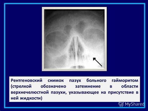 Причины тотального затемнения гайморовых пазух у взрослых