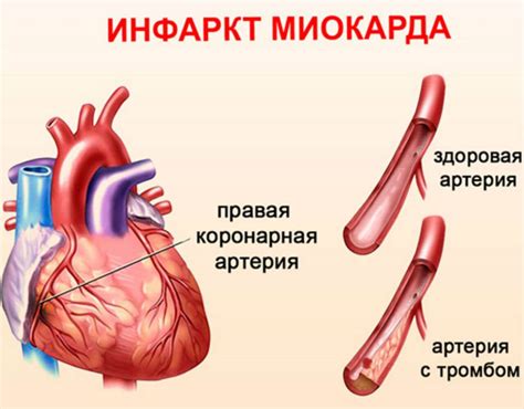 Причины трофических изменений миокарда