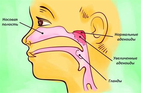Причины увеличения аденоидов и основные симптомы