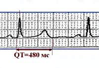 Причины увеличения интервала QT