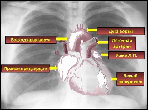 Причины увеличения сердца на рентгене