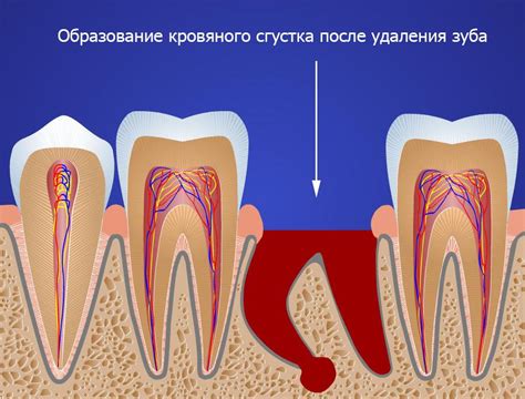 Причины удаления корня зуба