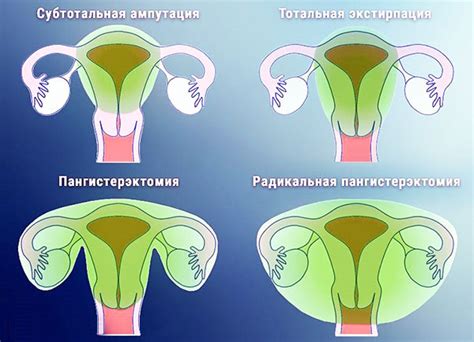 Причины удаления матки