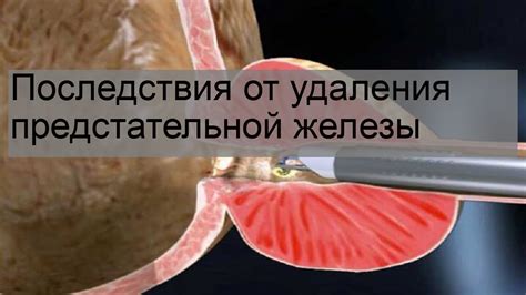 Причины удаления предстательной железы