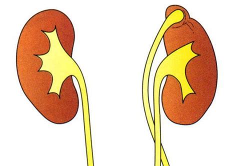 Причины удвоения члс левой почки у ребенка