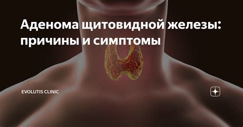 Причины уменьшения щитовидной железы