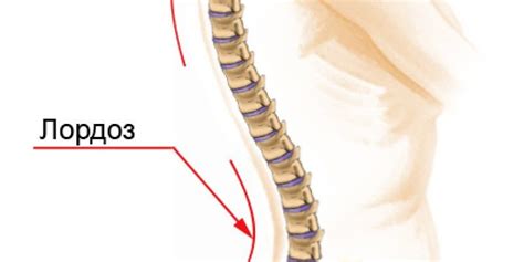 Причины умеренной выраженности лордоза