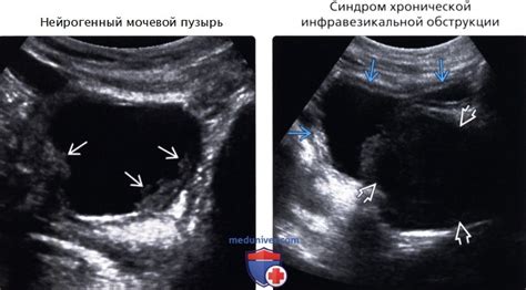 Причины уплотнения стенок мочевого пузыря