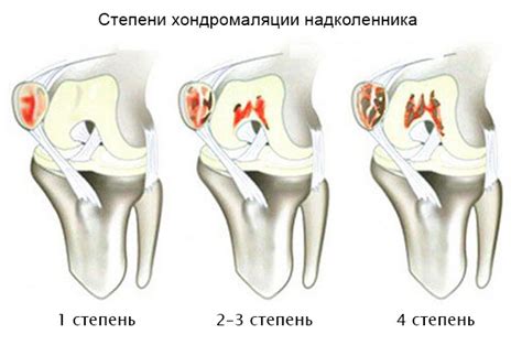 Причины хондромаляции правого надколенника