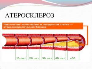 Причины экстравазальной компрессии позвоночной артерии