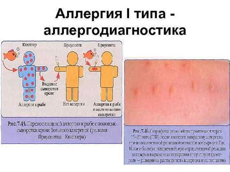 Проба Сулковича в диагностике аллергических реакций у детей