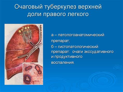 Проблема очагов туберкулеза