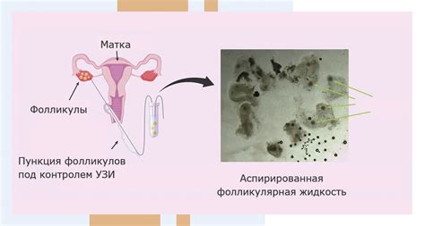 Проблема пустых фолликулов