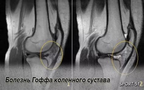 Проблема увеличения гоффа коленного сустава