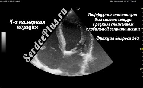 Проблемы окружающей среды и расширение стенок сердца