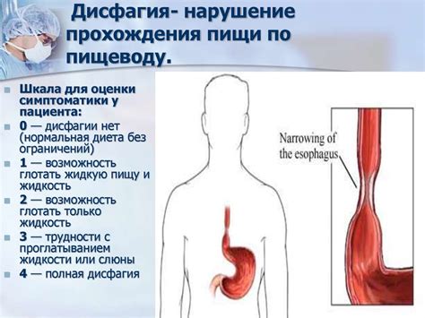 Проблемы с прохождением пищи по пищеводу: причины и лечение