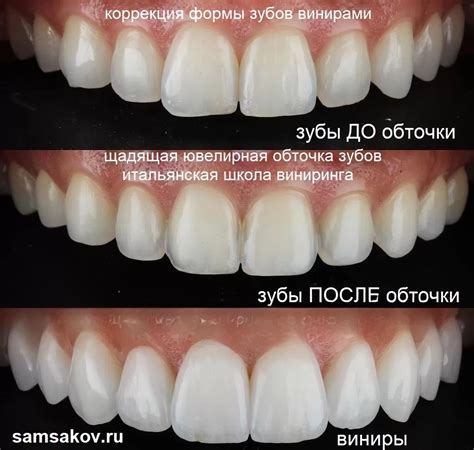 Прогнозируемые риски и ограничения в установке виниров