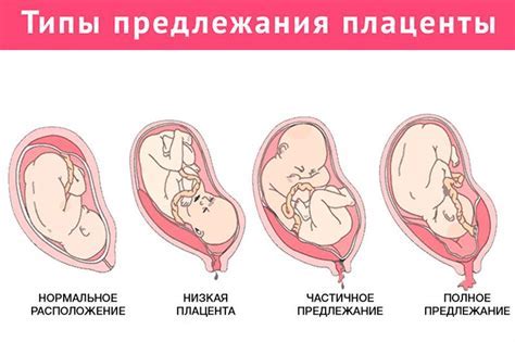 Прогноз и возможности предотвращения утолщенной плаценты